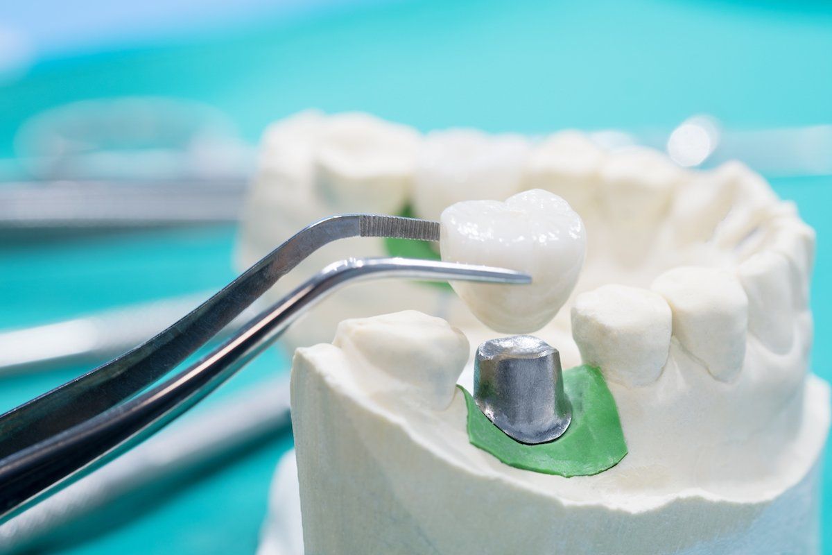 Crown Creation: Tools for Fabricating Dental Crowns