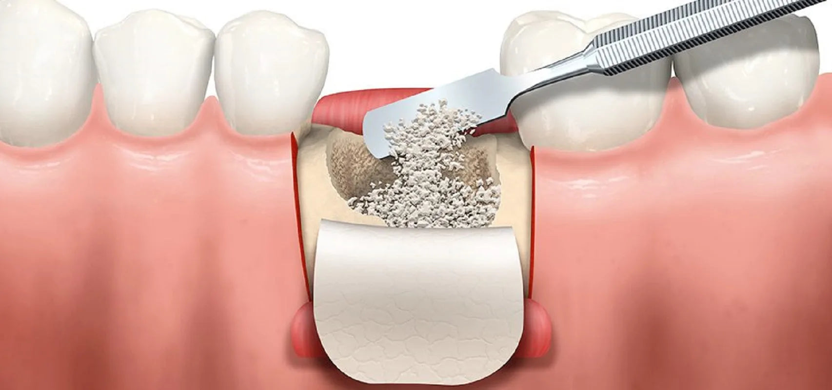 Understanding Bone Grafts in Dentistry: Uses, Types, and Benefits