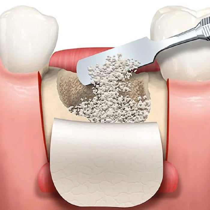 Understanding Bone Grafts in Dentistry: Uses, Types, and Benefits