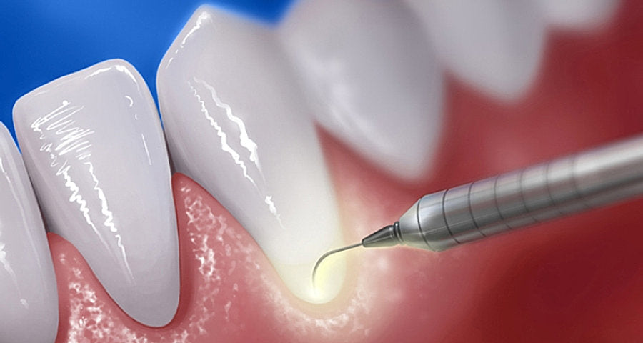 Periodontal Tools: Enhancing Gum Health