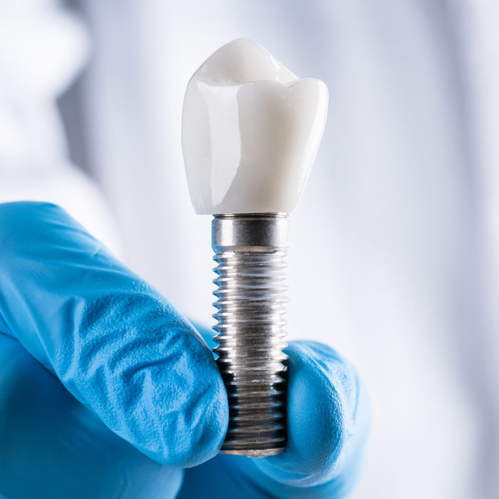 Choosing Between Dental Implants and Dentures